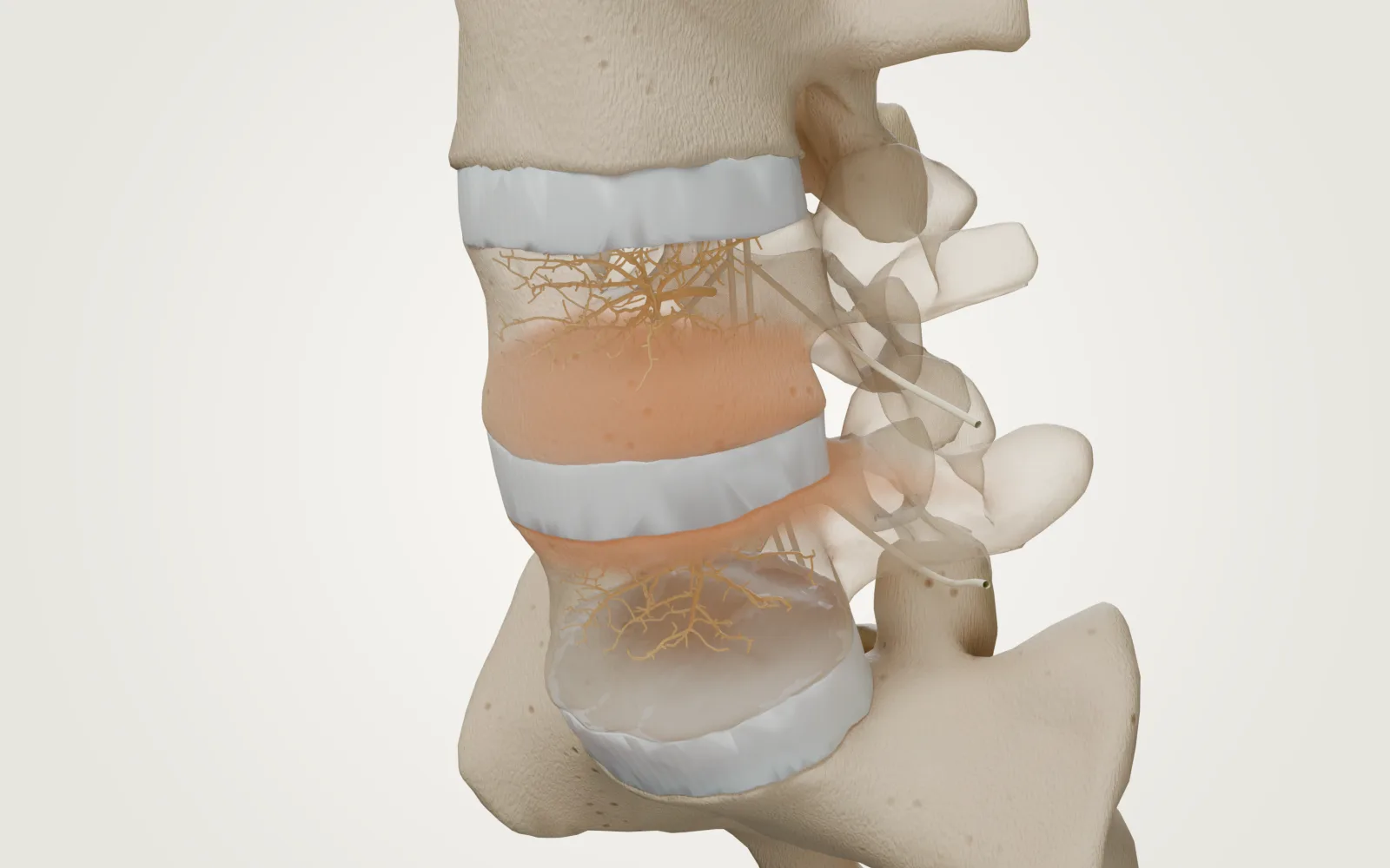 Illustrative L4–L5 spinal segment with a Modic change shown as a coloured band in the marrow beside the facing endplates.