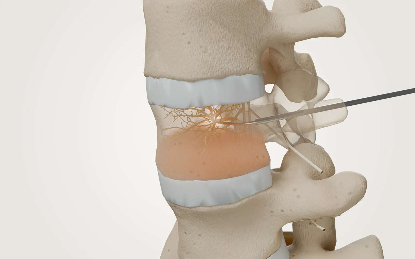 Illustrative L4–L5 spinal segment during basivertebral nerve ablation, with the probe inside the vertebral body and the heated zone around the nerve.